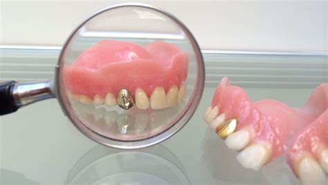 Bijwerkingen van gouden kappen in tanden